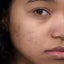 Legame tra acne e salute mentale: capire l'impatto psicologico dell'acne